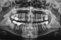 news nervo alveolare inferiore