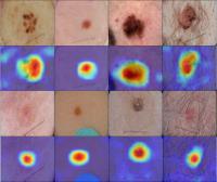 Skin Lesion Analysis